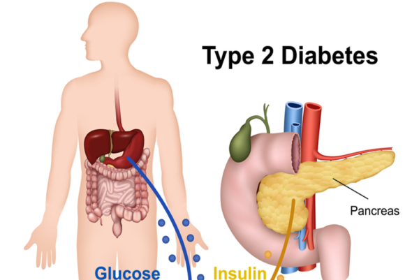 Can You Reverse Type 2 Diabetes? All You Need To Know - Viedial - Can You Reverse Type 2 Diabetes