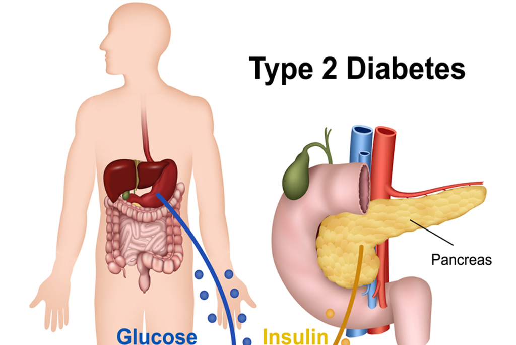 Can You Reverse Type 2 Diabetes? All You Need To Know